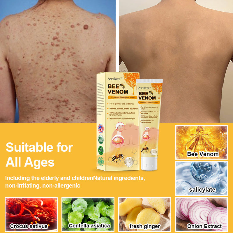 Awzlove™ Bee Venom Lipomas Therapy Cream (Doctor recommended and effective)🐝