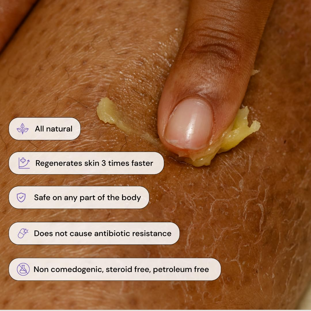 Awzlove™ Bee Venom Lipomas Therapy Cream (Doctor recommended and effective)🌟